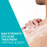 Crema espumosa para el acné CeraVe con peróxido de benzoilo al 10%, 150 ml