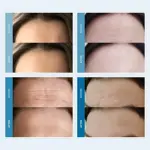Parches para Arrugas en la Frente Dersie - Pack de 3