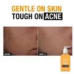 Limpiador facial Neutrogena, sin aceite, acné, 2% ácido salicílico, 270 ml