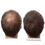 Aceite de palma enana americana PHYTO LIFE, 30 ml, bloqueador de DHT natural orgánico