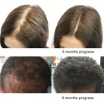 Aceite de palma enana americana PHYTO LIFE, 30 ml, bloqueador de DHT natural orgánico