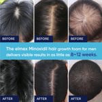 Kit de espuma de minoxidil Artimore 5% para hombres y mujeres, 60 ml