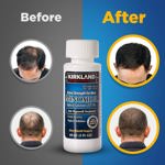 Tratamiento para el crecimiento del cabello para hombres durante 6 meses
